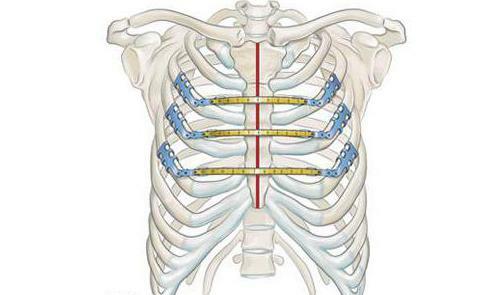 Fracture of sternum treatment