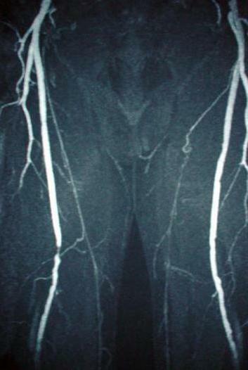 angiography of the vessels of the lower extremities