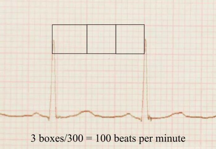 Bir EKG okumayı öğrenme