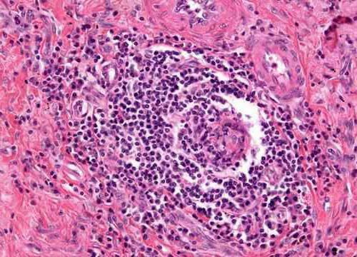 sarcoidosis of the skin