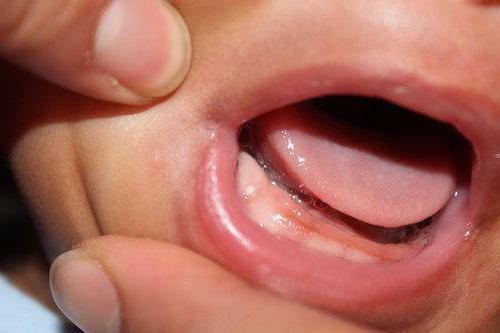 a child on the upper gums ulcer Photo