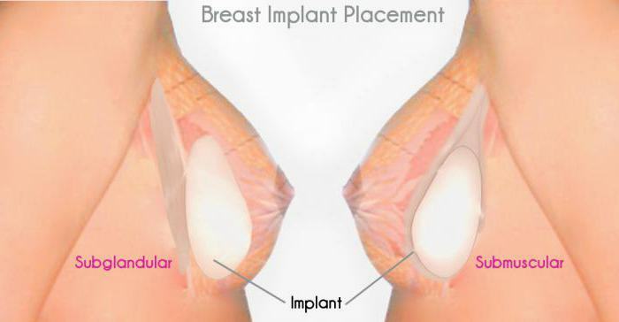 mammoplasty before and after