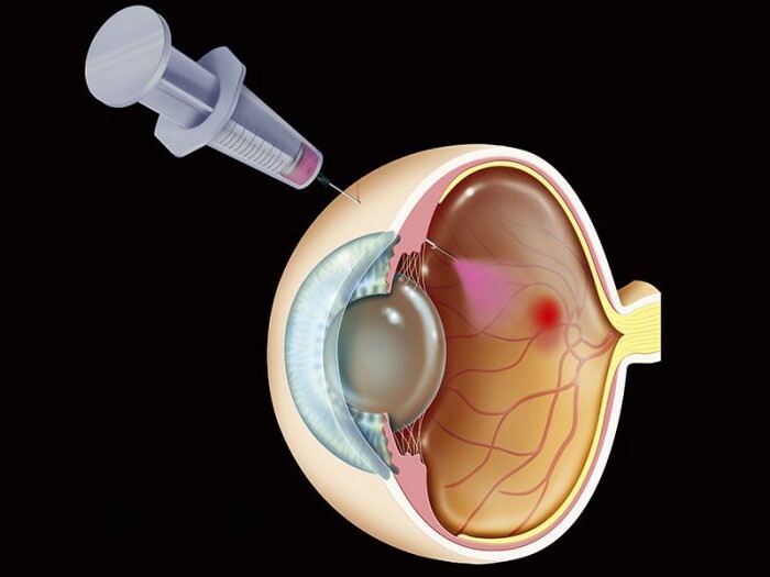 injections avastina in the eye reviews