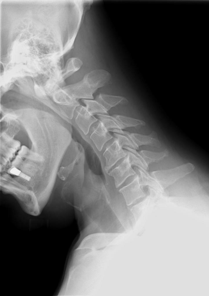 X-ray of the cervical