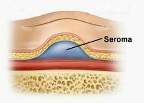 سيروما التماس ما بعد الجراحة ما هو؟