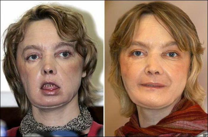 face transplantation before and after photos