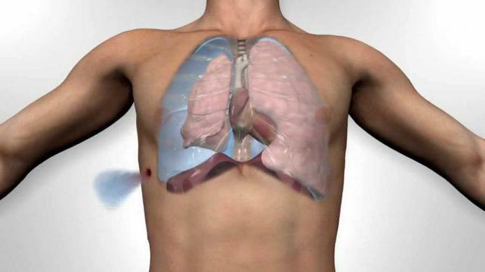 pneumothorax types