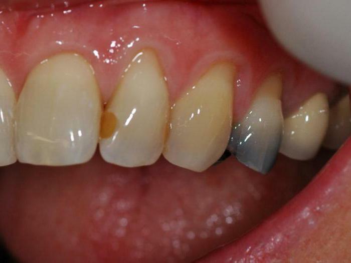pluses and minuses of metal fillings for teeth