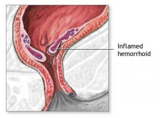 Ointment for hemorrhoids during pregnancy