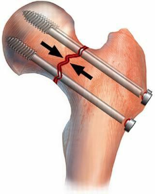 uzavretá zlomenina bedra