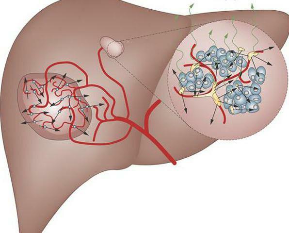 hepatitis C i hepatocelularni karcinom