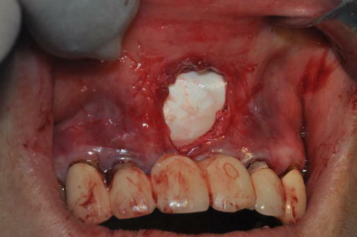 Bone plasty during implantation of teeth complications