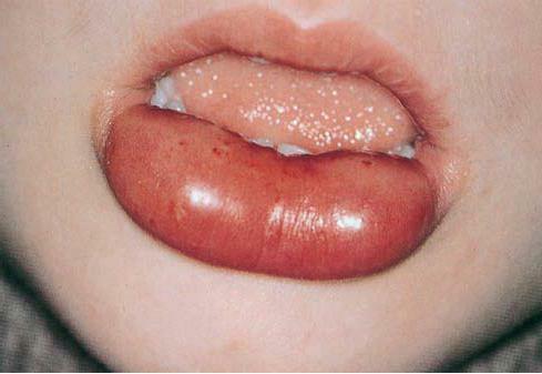 angioedema, what is it?