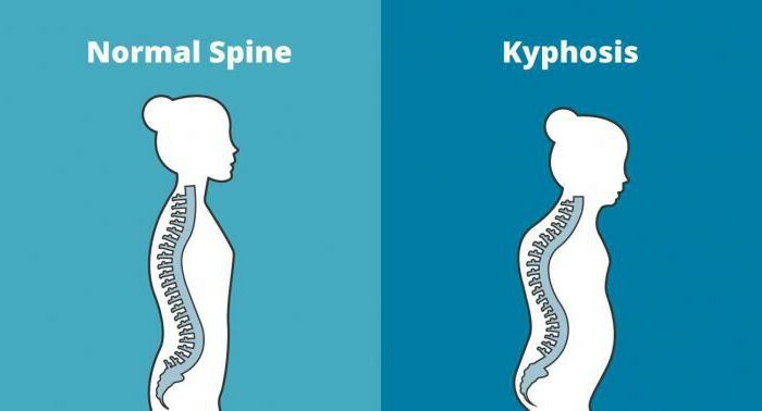 kyphosis of the cervical spine