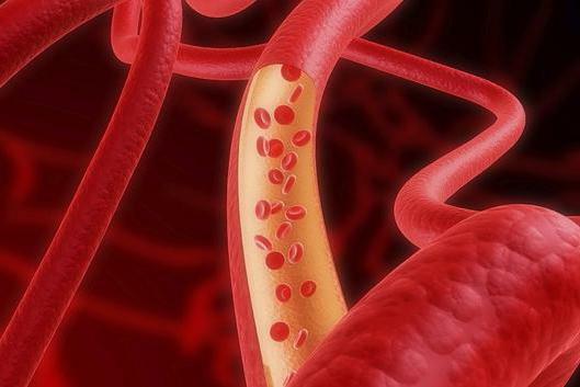 angiography of the vessels of the lower extremities of contraindication