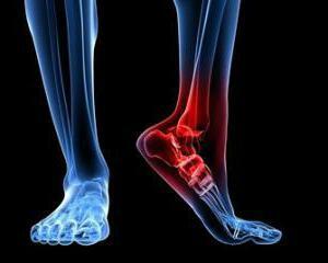 Post-traumatic arthrosis of the ankle