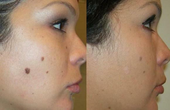 whether it is possible to remove flat birthmarks on the face