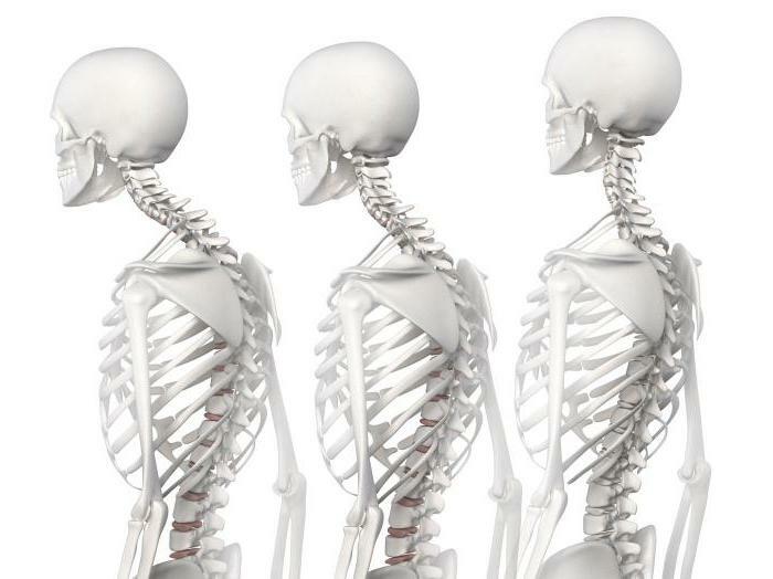exercises with kyphosis