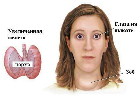 acute thyroiditis treatment