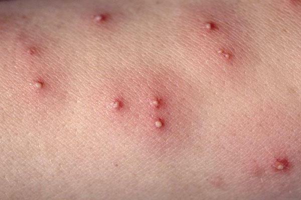flea bites on man treatment