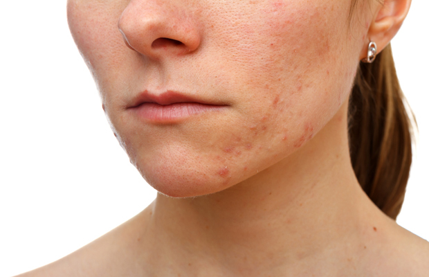 Features of cystic acne