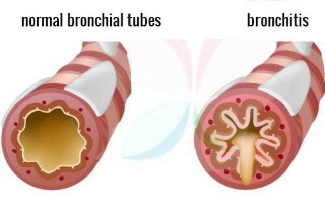 the main cause of bronchitis