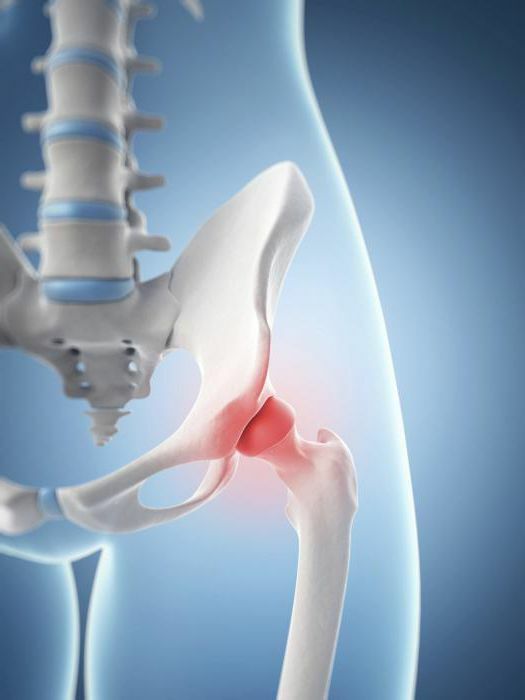 Vertical bursitis of the hip joint Symptoms