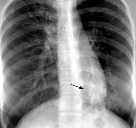 disseminated pulmonary tuberculosis in the phase of decay