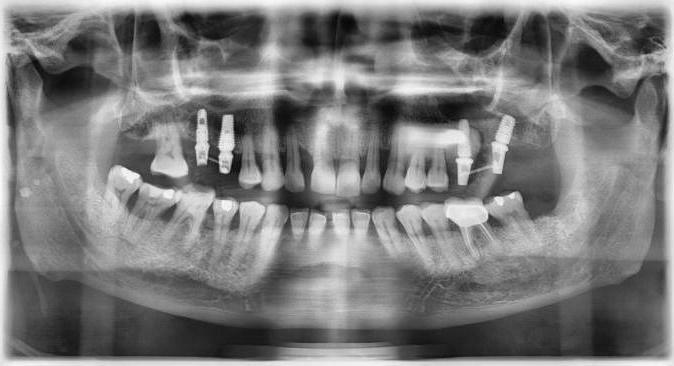 how much is a tooth implant