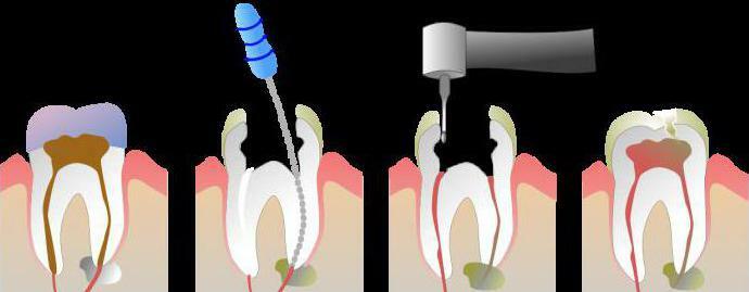 it is painful to remove the nerve from the tooth