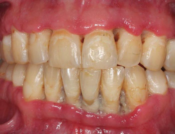 akut gingivitis kliniği