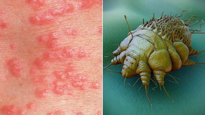 scabies príznaky liečby doma