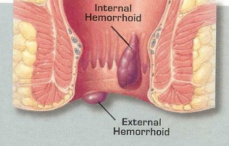 types of hemorrhoids