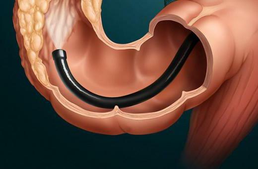sigmoidoscopy and colonoscopy of difference