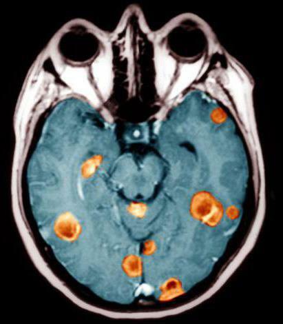posledná etapa rakoviny mozgu