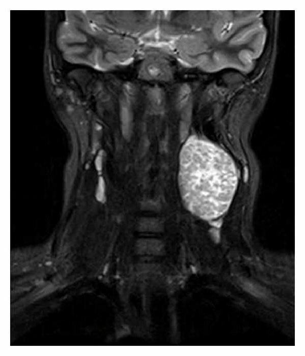 mrt lymph nodes of the neck that shows