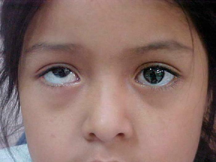 What is the name of the disease, when eyes look in different directions?