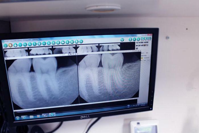 apikal periodontitisin teşhis yöntemleri