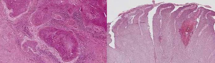 tratamentul carcinomului cu celule scuamoase a colului uterin