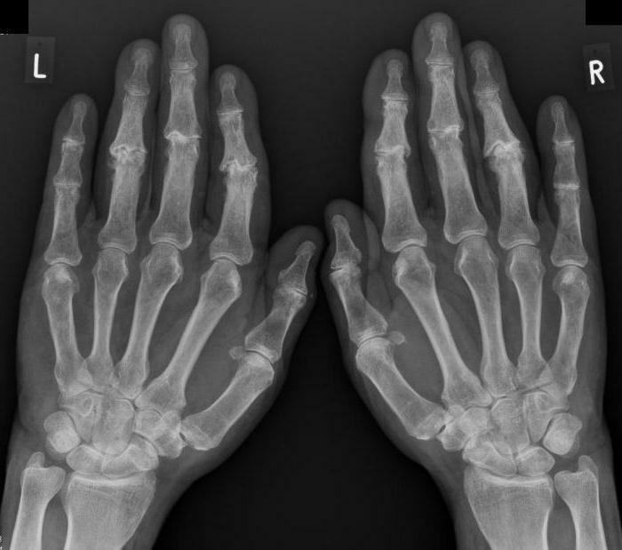 osteoarthritis of hands
