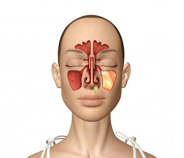 nasal rhinitis