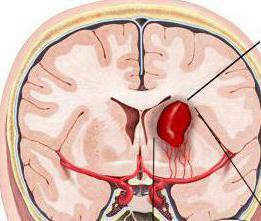 intracranial hematoma symptoms