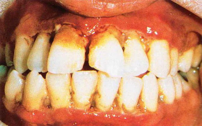 Akut gingivitis nedenler, semptomlar ve tedavi özellikleri