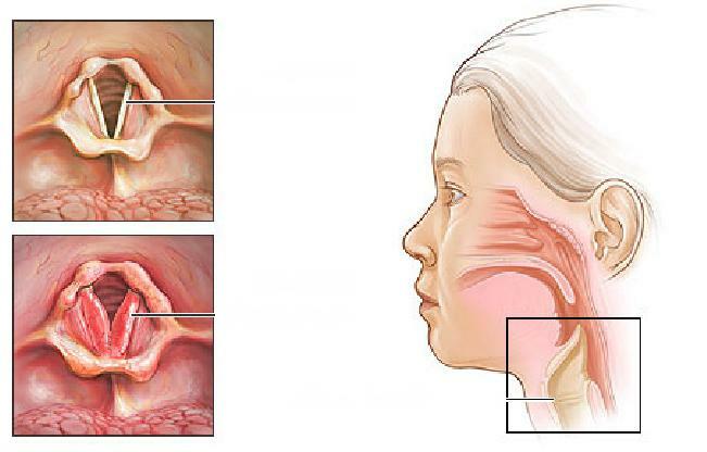Liečba akútneho laryngitídy u detí