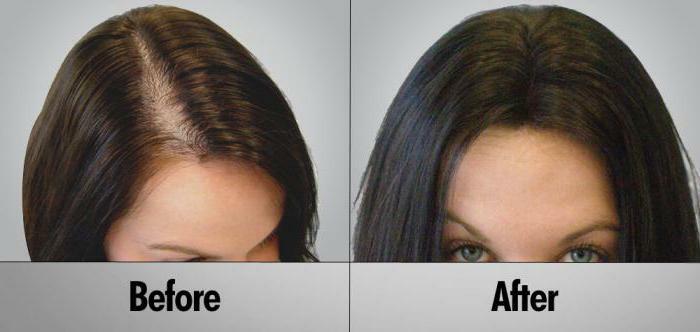 hair loss treatment darsonvalem