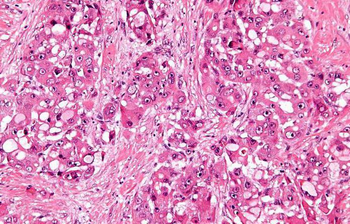 hepatocelularni karcinom prognostičke jetre