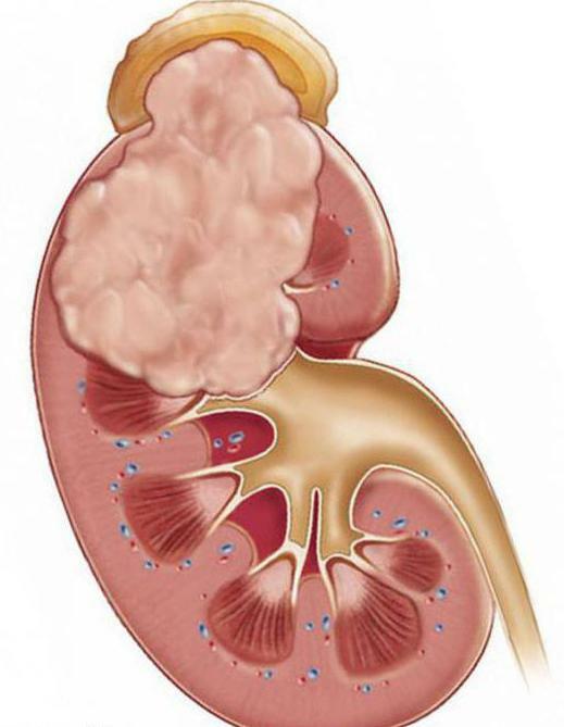 computed tomography of the kidneys
