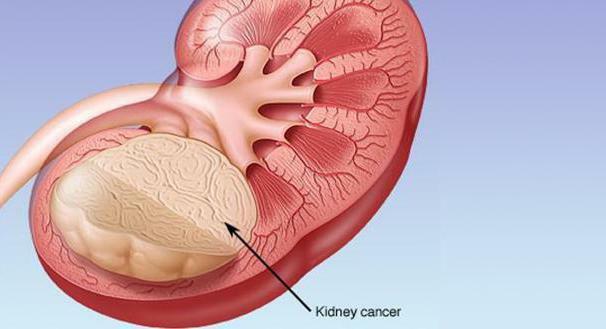 kidney removal in cancer