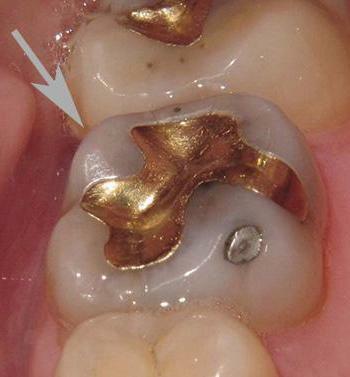 metal fillings for teeth