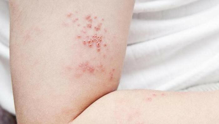 rash under the arms in adults
